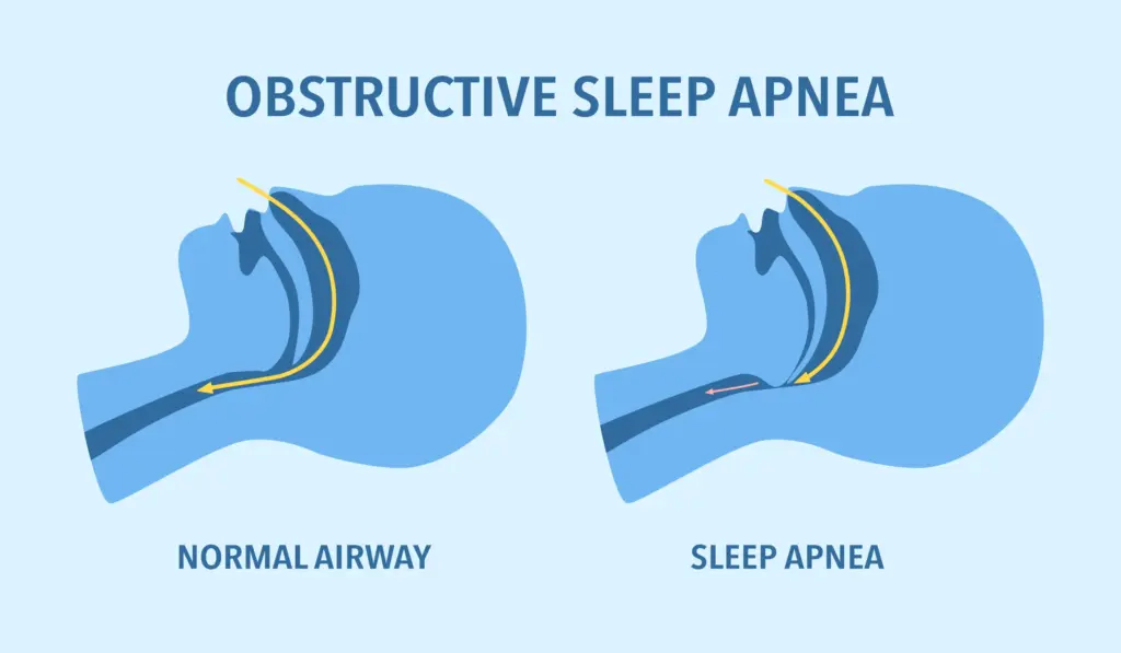 Sleep apnea discussion during HGV driver medical